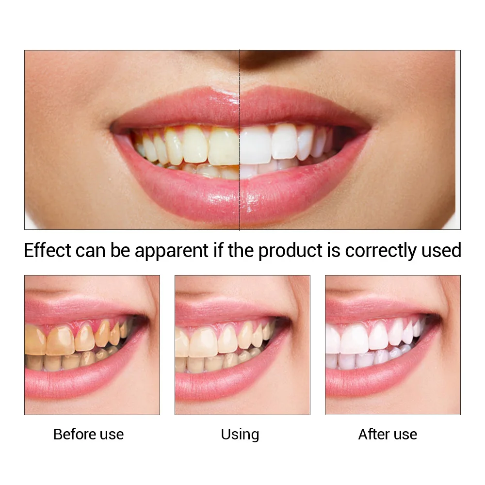 FTEENPLY Teeth Whitening Essen - Teeth Whitening Ulta ulasan dan harga