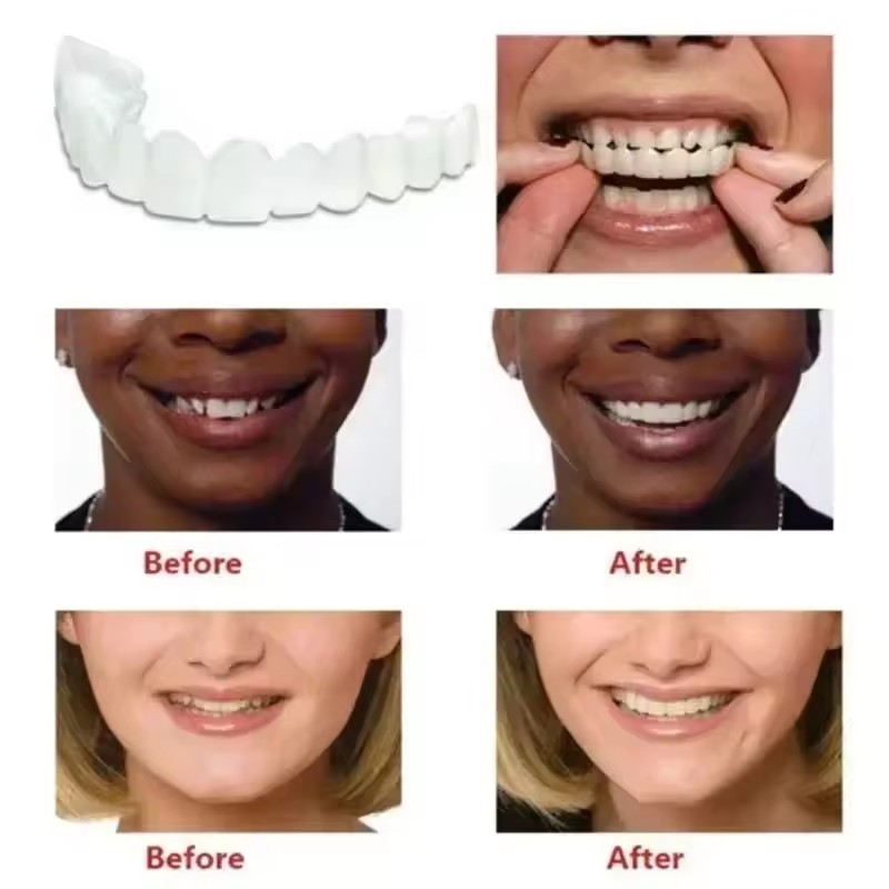 Teeth Veneers Whitening Dentur - Teeth Whitening With Braces ulasan dan harga