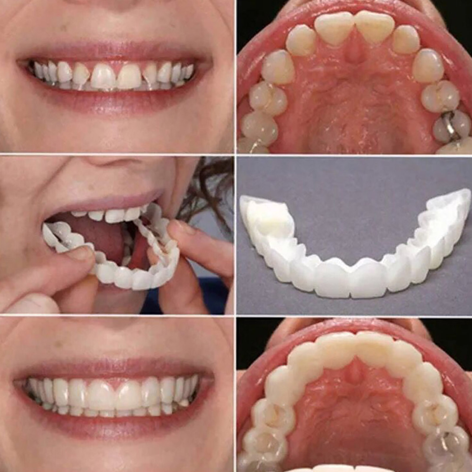Hot Teeth Veneers Whitening De - Teeth Whitening With Braces ulasan dan harga