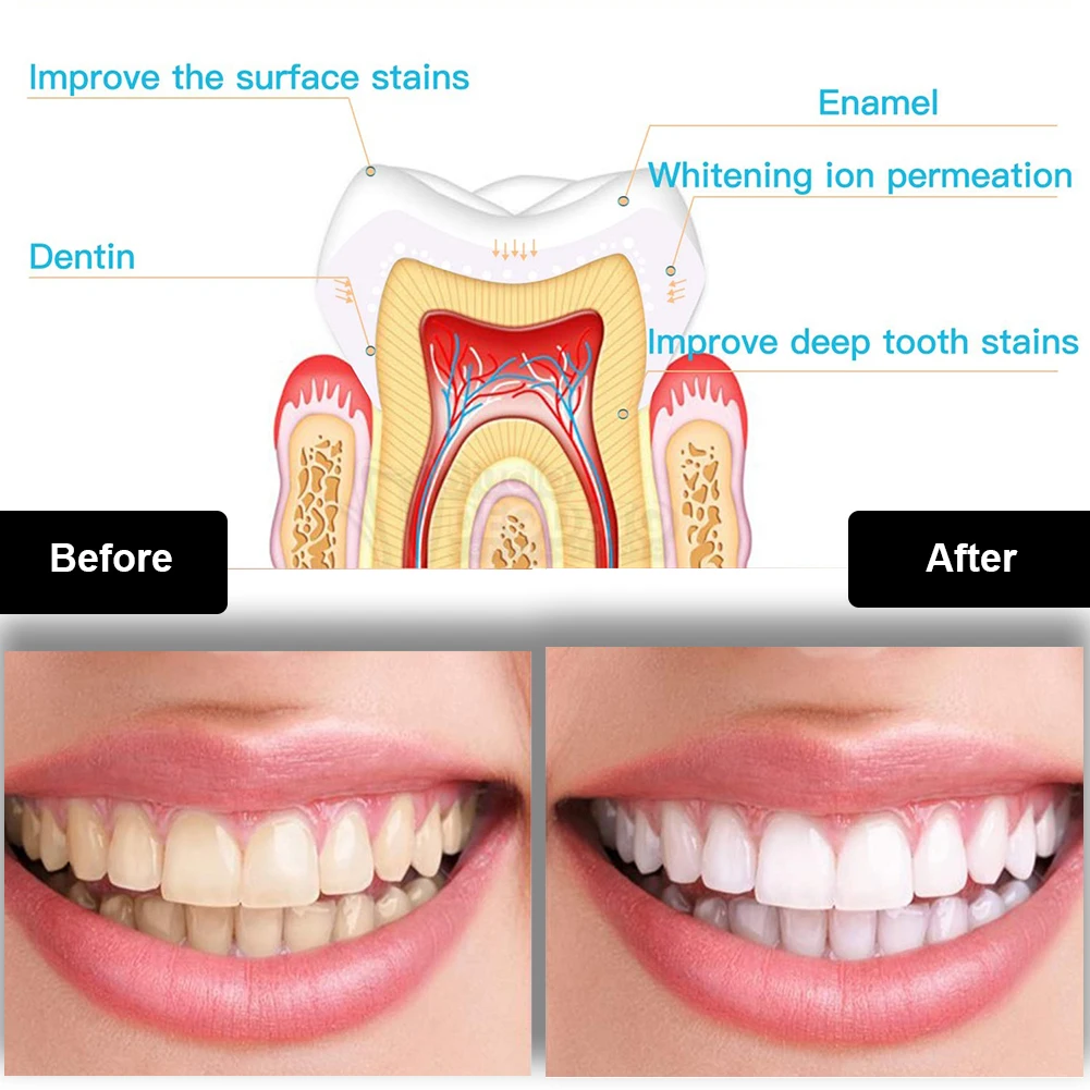 Dental Teeth Whitening Kit Min - Teeth Whitening Gel Peroxide ulasan dan harga